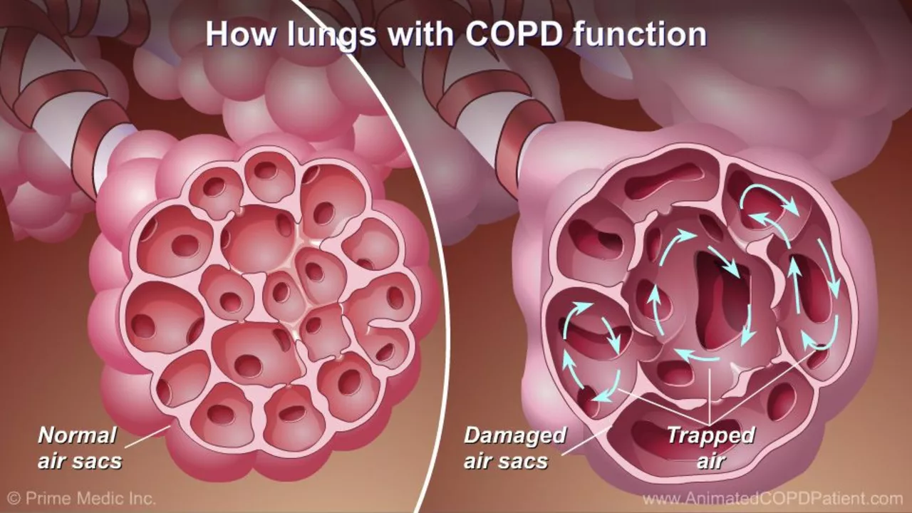How budesonide helps in managing chronic obstructive pulmonary disease (COPD)