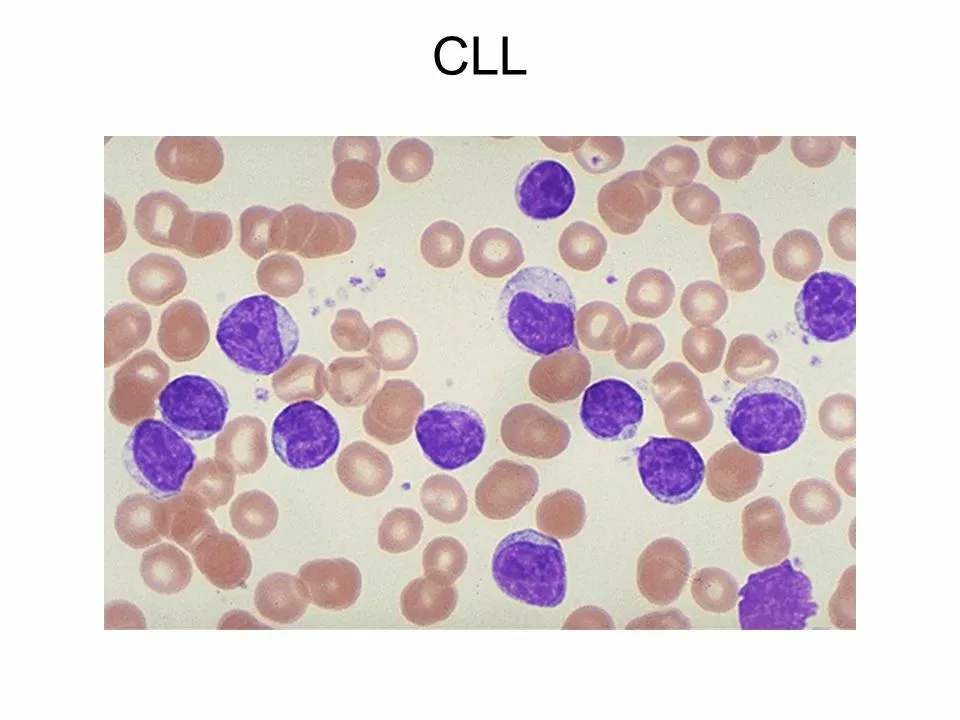 Living with Chronic Lymphocytic Leukemia: Tips for Maintaining Quality of Life