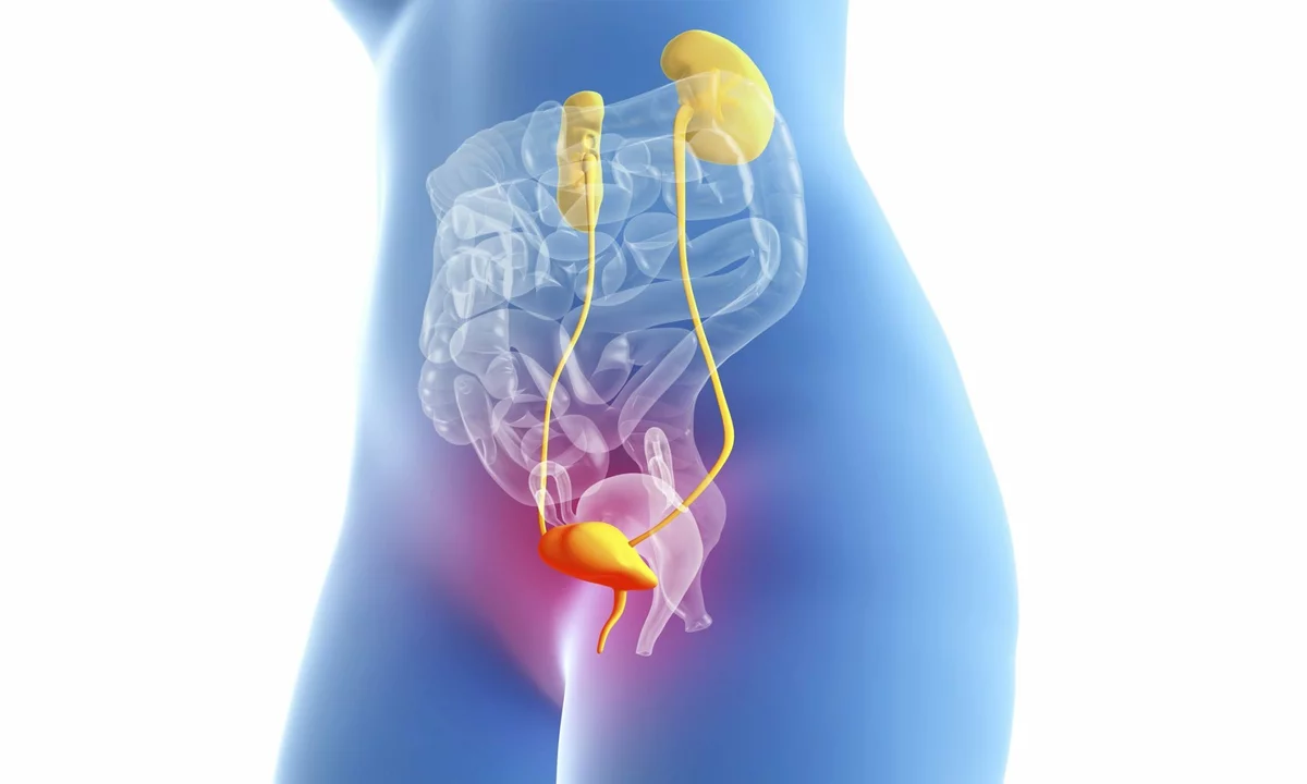 The Connection Between Cystitis and Bladder Stones