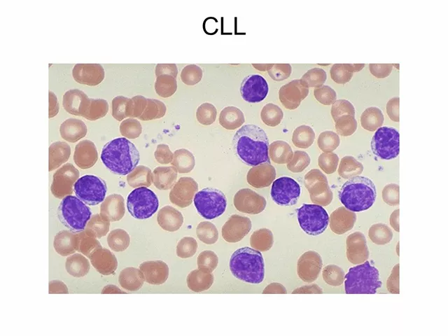 Living with Chronic Lymphocytic Leukemia: Tips for Maintaining Quality of Life